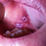 Лейкоплакия слизистой оболочки рта