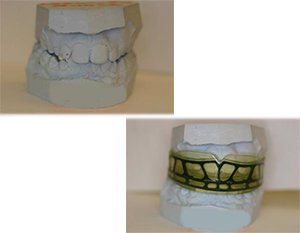 Правильный прикус и ровные зубы с ортодонтическими трейнерами