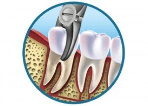 Удаление зубов – все «за» и «против»