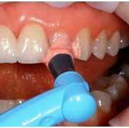 Современная стоматология рекомендует гигиеническую чистку зубов