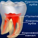 Профилактика и лечение пульпита – проблема с зубами