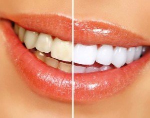 Отбеливание зубов – сделай свою улыбку ярче!