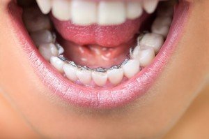 Брекеты — самое эффективное средство коррекции зубов