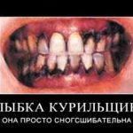 Курение и зубы. Как избежать неприятных последствий?
