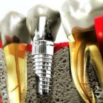 Зубная имплантация: мифы и страшилки