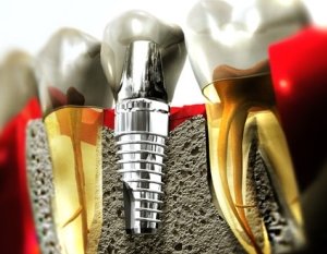 Зубная имплантация: мифы и страшилки 