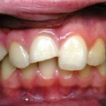 Травма зуба и лечение