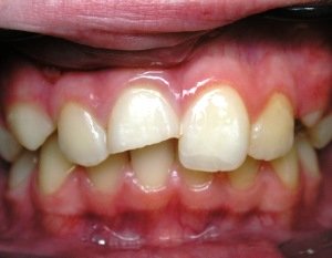 Травма зуба и лечение