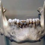 Брекет-системы – панацея для красивой улыбки