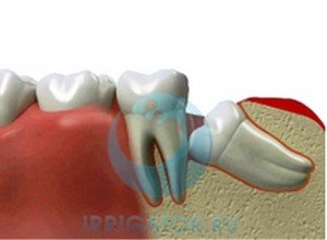 Зубы мудрости и современная стоматология