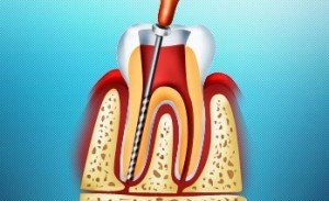 Современная стоматология: частичное и полное депульпирование