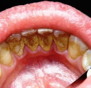 Зубной камень: удаление и причины возникновения