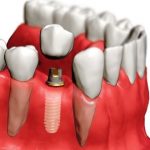 Коронки, как эффективный стоматологический ход