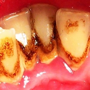 Зубной камень, как предпосылка образования кариеса