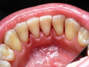 Зубной камень, как предпосылка образования кариеса