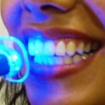 Лазерное отбеливание зубной эмали