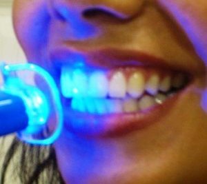 Лазерное отбеливание зубной эмали 