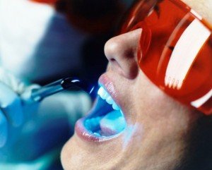 Лазерное отбеливание зубной эмали 
