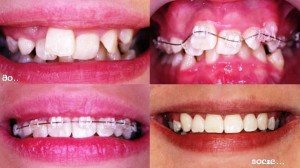 Проблемы с зубами у детей при неправильном прикусе, причины их возникновения
