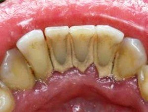 Чем опасен зубной налет