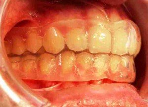 Ортодонтические трейнеры – лечим зубные аномалии эффективно!