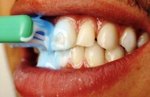 Зубной налет в ротовой полости: норма или отклонение?