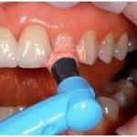 Современная стоматология рекомендует гигиеническую чистку зубов