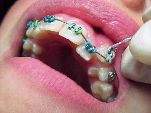 Искривление зубов? Стоматологическая клиника поможет 