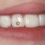 Скайсы, как украшение и отбеливание зубов