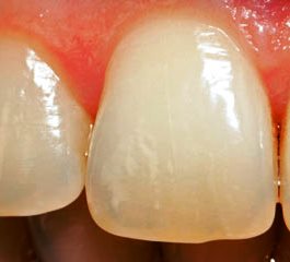 Восстановление зубной эмали 
