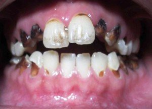 Восстановление зубной эмали 