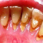 Зубной камень и налет на зубах