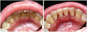 Зубной камень и налет на зубах