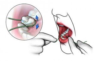 Особый уход за полостью рта или большие проблемы маленьких зубных промежутков