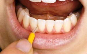 Особый уход за полостью рта или большие проблемы маленьких зубных промежутков