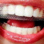 Отбеливание зубов: отбеливающие полоски, пасты