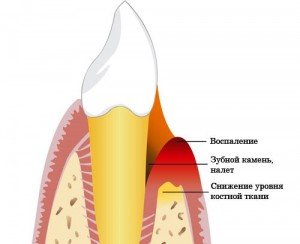 Проблемы с зубами, вызванные пародонтозом 