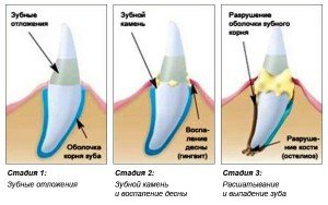 Проблемы с зубами, вызванные пародонтозом 