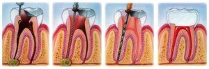 Профилактика и лечение пульпита – проблема с зубами
