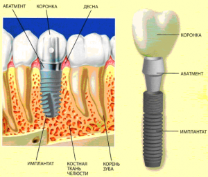 Имплантация зубов – решение многих проблем