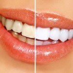 Отбеливание зубов – сделай свою улыбку ярче!