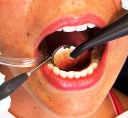 Проблемы с зубами у больных с ревматическими заболеваниями