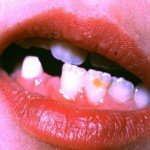 Чем опасна гипоплазия зубов?