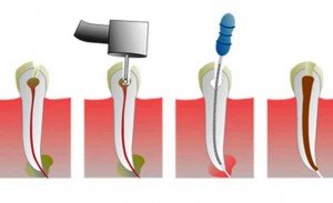 Нерв зуба: особенности удаления
