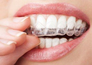 Домашнее отбеливание зубов: насколько это эффективно