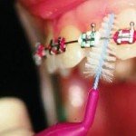 Зубные ершики – надежная страховка от стоматологических недугов