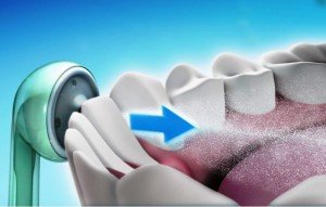 Ирригатор – основа ухода за полостью рта с ортодонтическими конструкциями