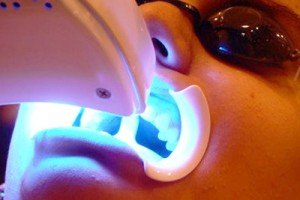 Отбеливание зубов и лазерные технологии
