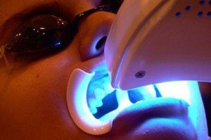 Отбеливание зубов и лазерные технологии