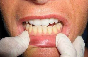 Отбеливание зубов и их лечение – скажите страху «нет»!